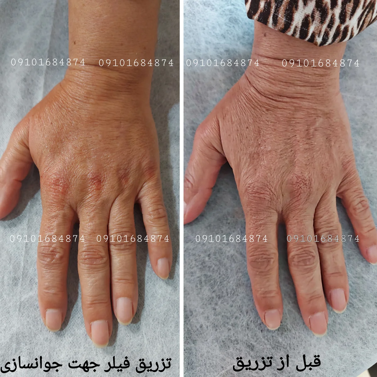 عکس قبل و بعد فیلر بدن