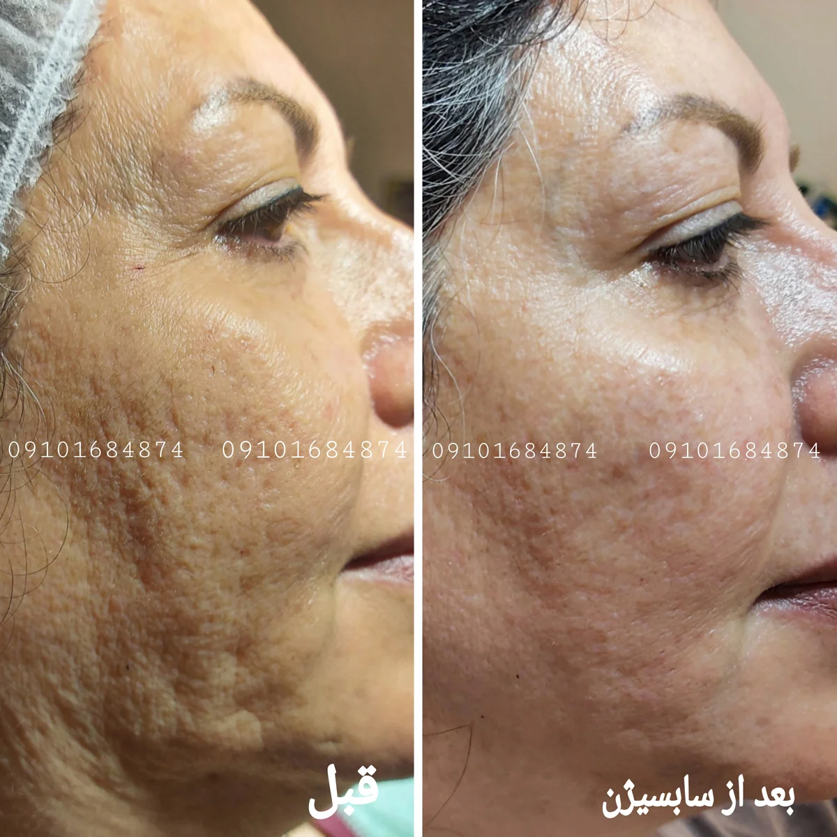 عکس قبل و بعد سابسیژن