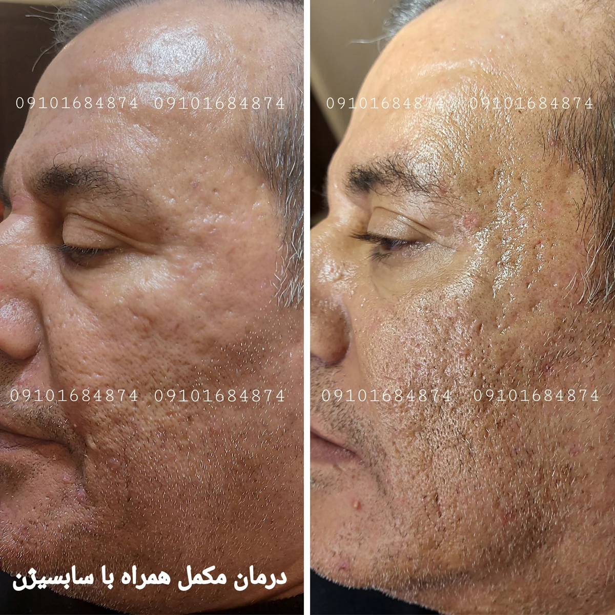 عکس قبل و بعد سابسیژن