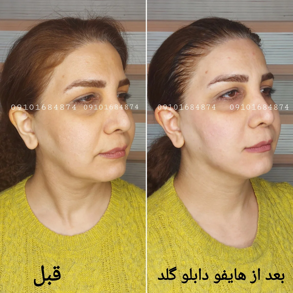 عکس قبل و بعد هایفو صورت