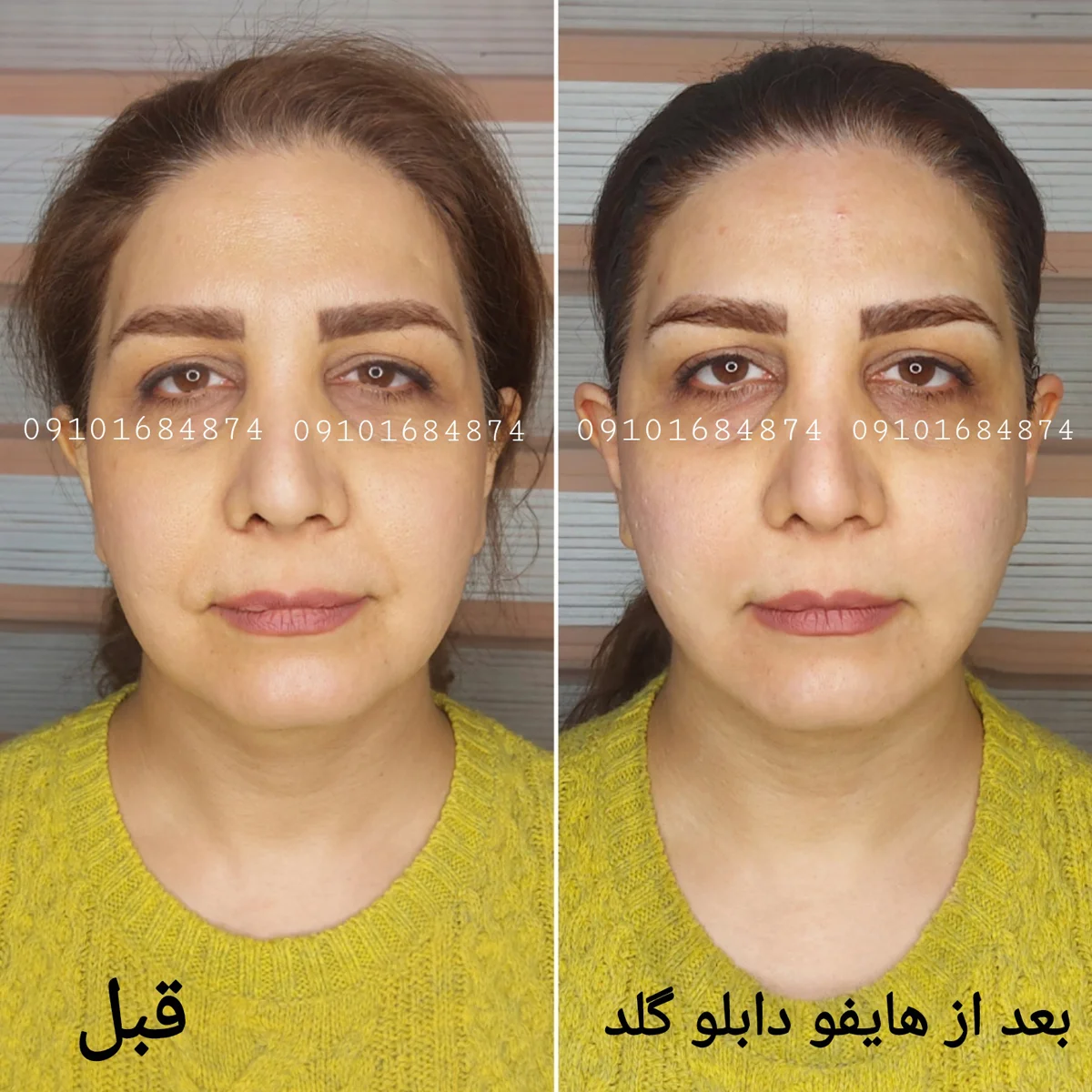 عکس قبل و بعد هایفو صورت